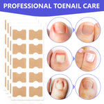 SEFUDUN Toenail Correction Stickers, pack of 100pcs