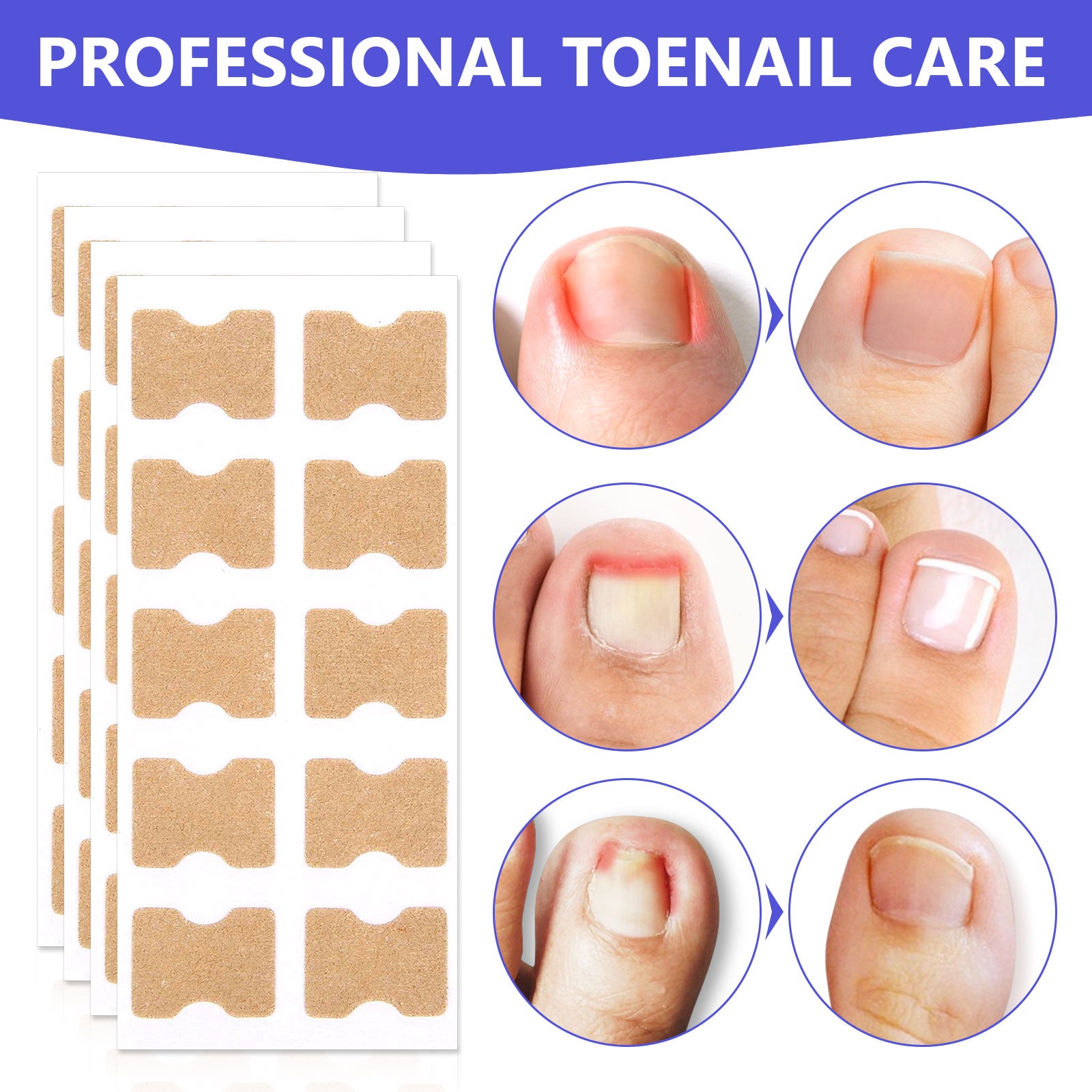 SEFUDUN Toenail Correction Stickers, pack of 100pcs