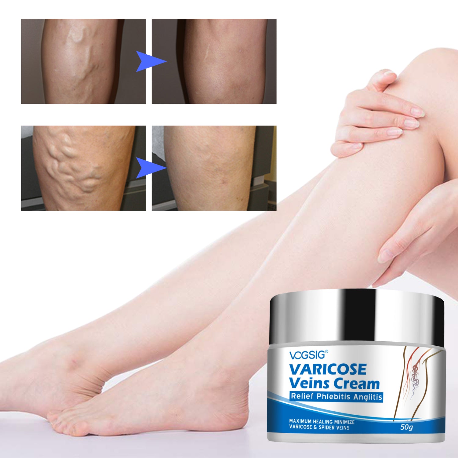 VOGSIG Varicose Veins Cream, 50g