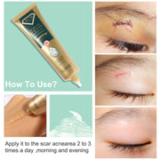 ELAIMEI TCM Scar And Acne Mark Removal Gel Cream, 30g