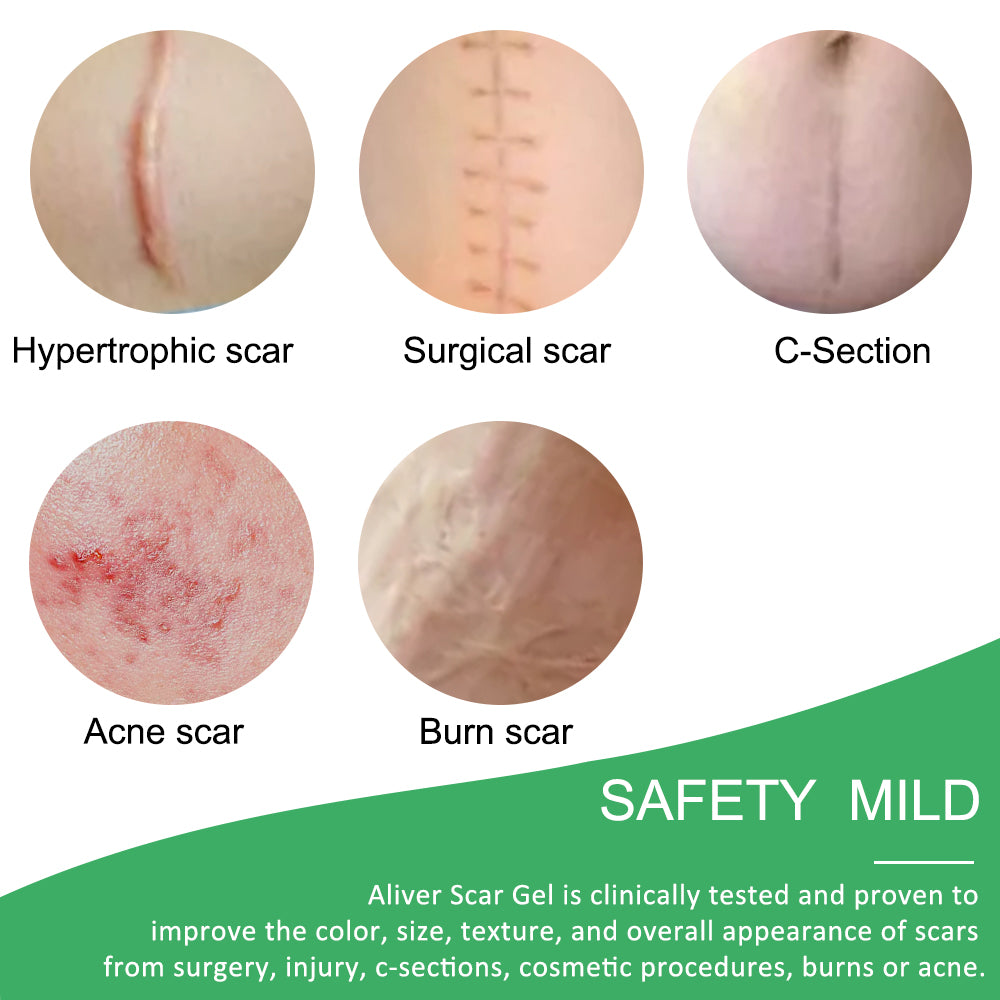 ALIVER Silicone Scar Sheets, Reduction Treatment, pack of 4pcs