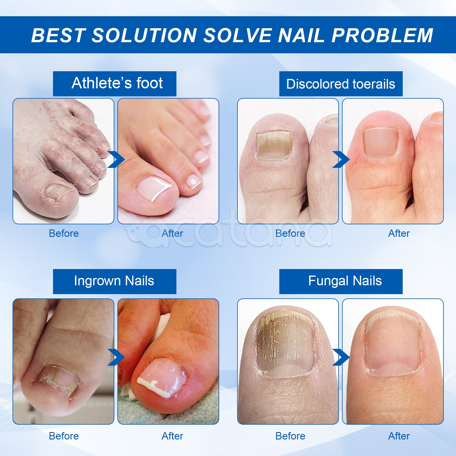 SEFUDUN Removal Paronychia Oil, 30ml