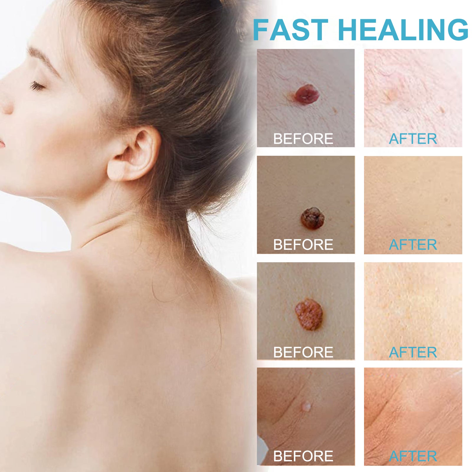 ELAIMEI Skin Tag Remover Kit, Anti Mole & Wart Body Pens, 4pcs