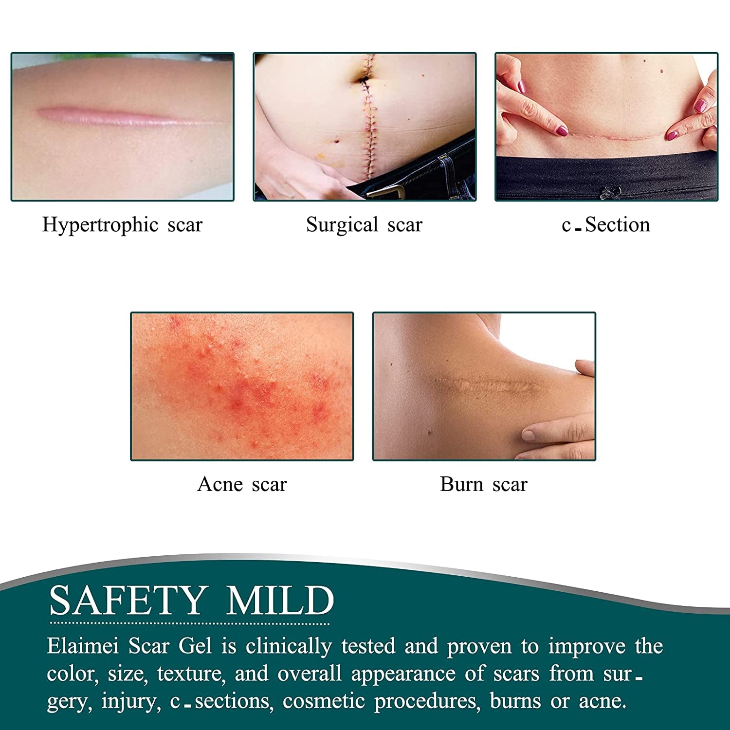 ELAIMEI Silicone Scar Removal Sheets, Roll Tape 3m