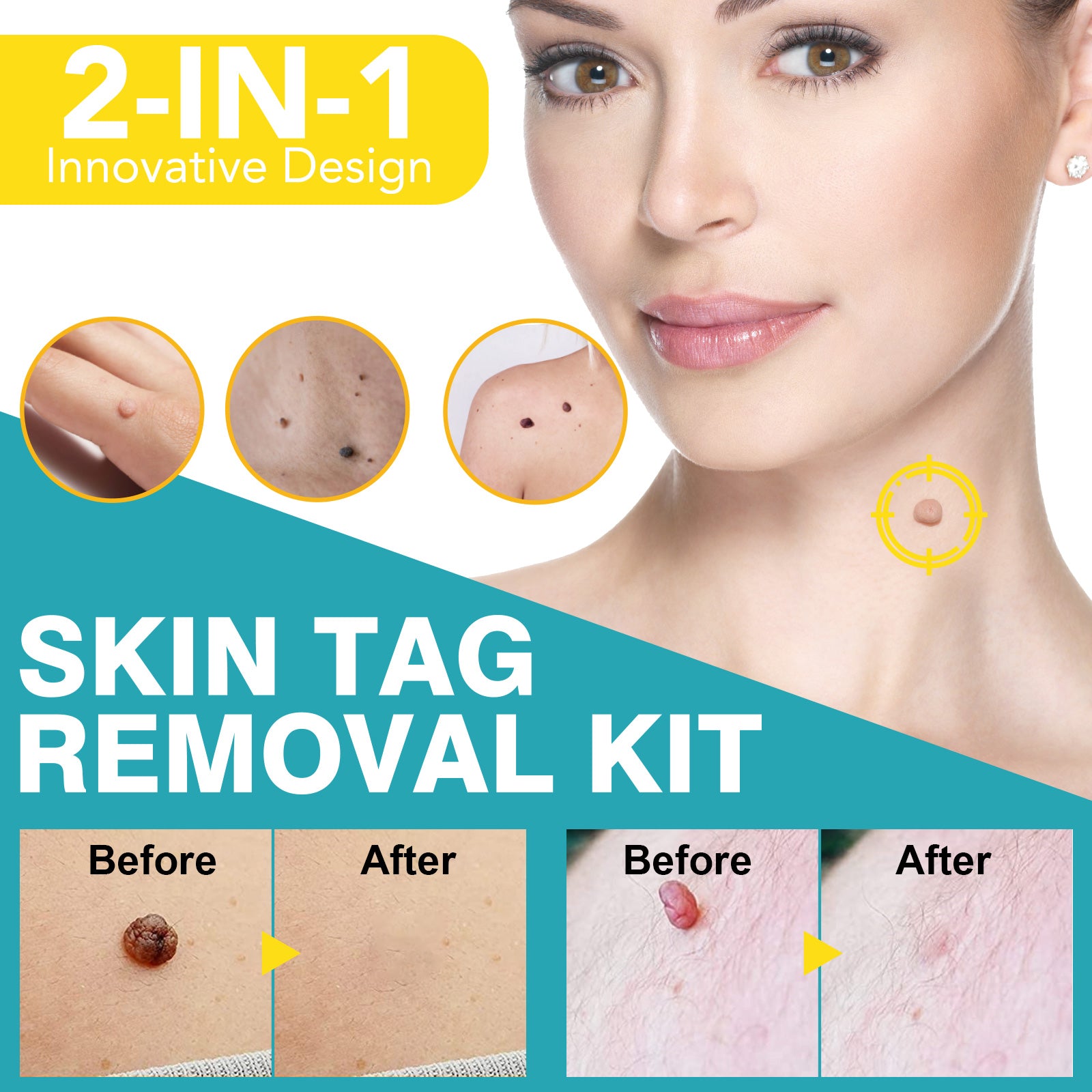 ELAIMEI 2in1 Fast & Effective Skin Tag Remover Kit