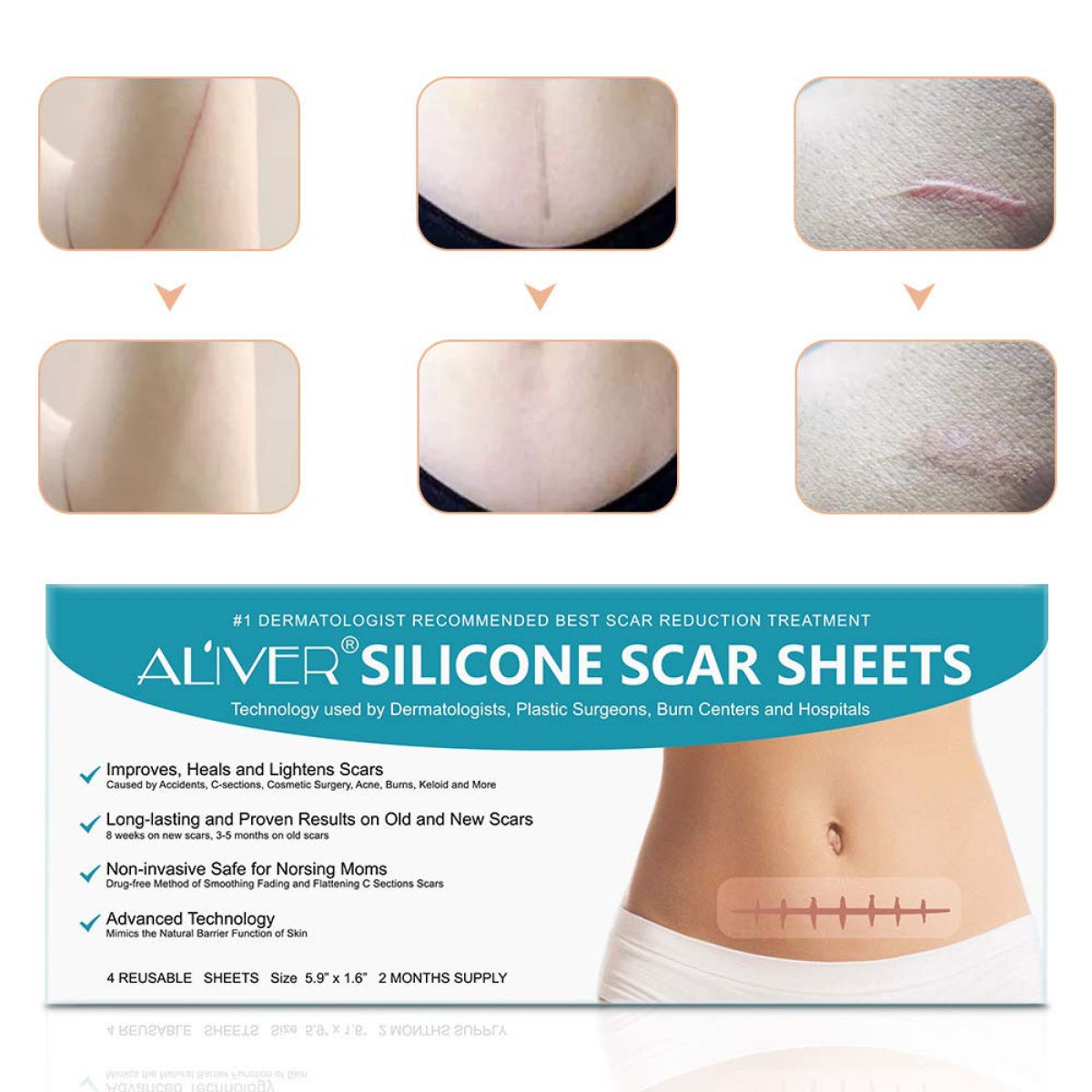 Aliver Silicone Gel Sheets for Scar Removal Treatment Repair