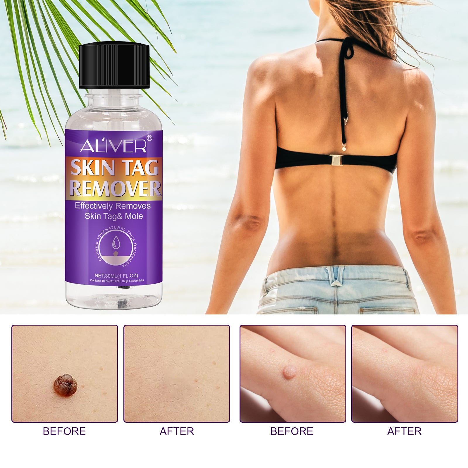 ALIVER Safe Skin Tag Removal Liquid, 30ml