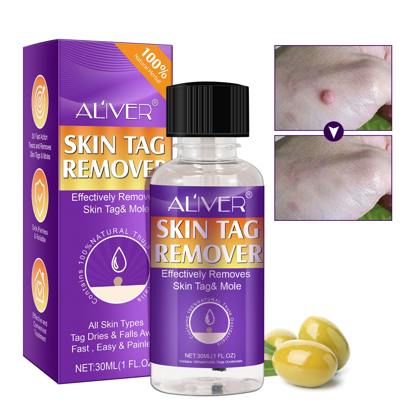 ALIVER Safe Skin Tag Removal Liquid, 30ml