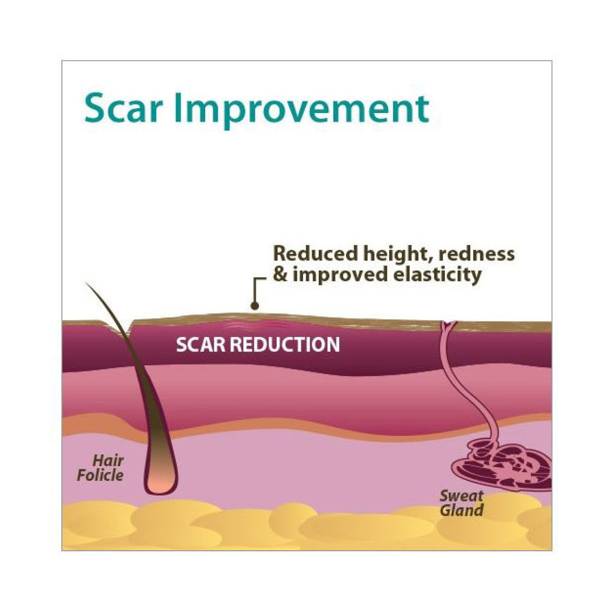 Aliver Silicone Gel Sheets for Scar Removal Treatment Repair