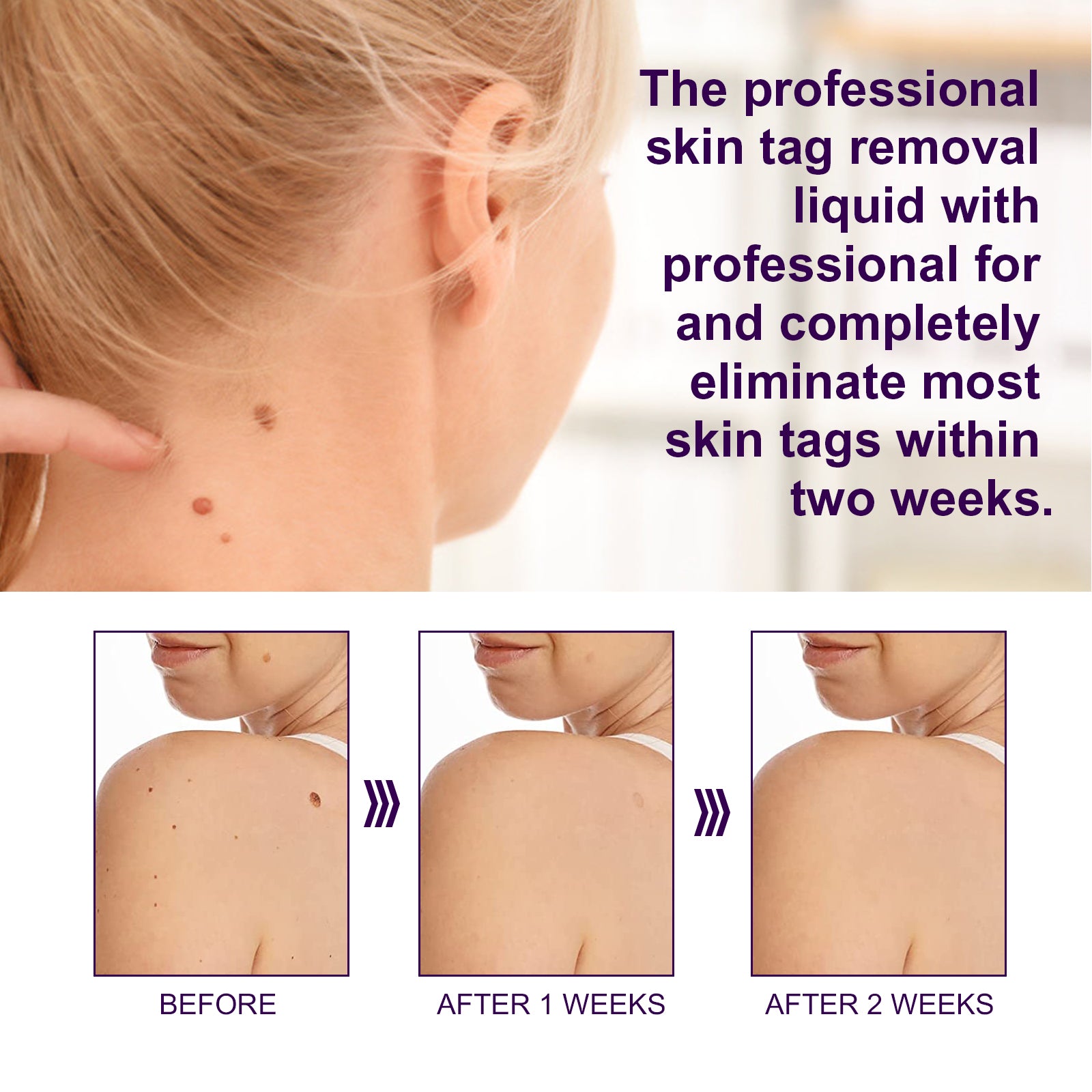 ALIVER Safe Skin Tag Removal Liquid, 30ml