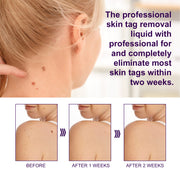 ALIVER Safe Skin Tag Removal Liquid, 30ml