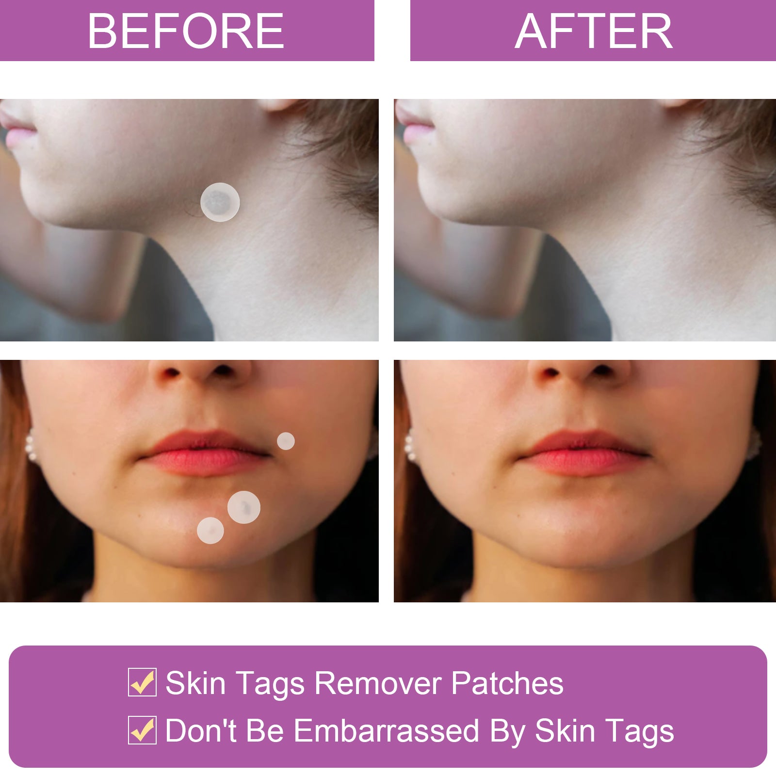 ELAIMEI Skin Tag, Acne & Wart Remover Patches, pack of 144pcs