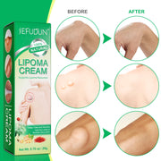 SEFUDUN Lipoma Removal Cream, 20g