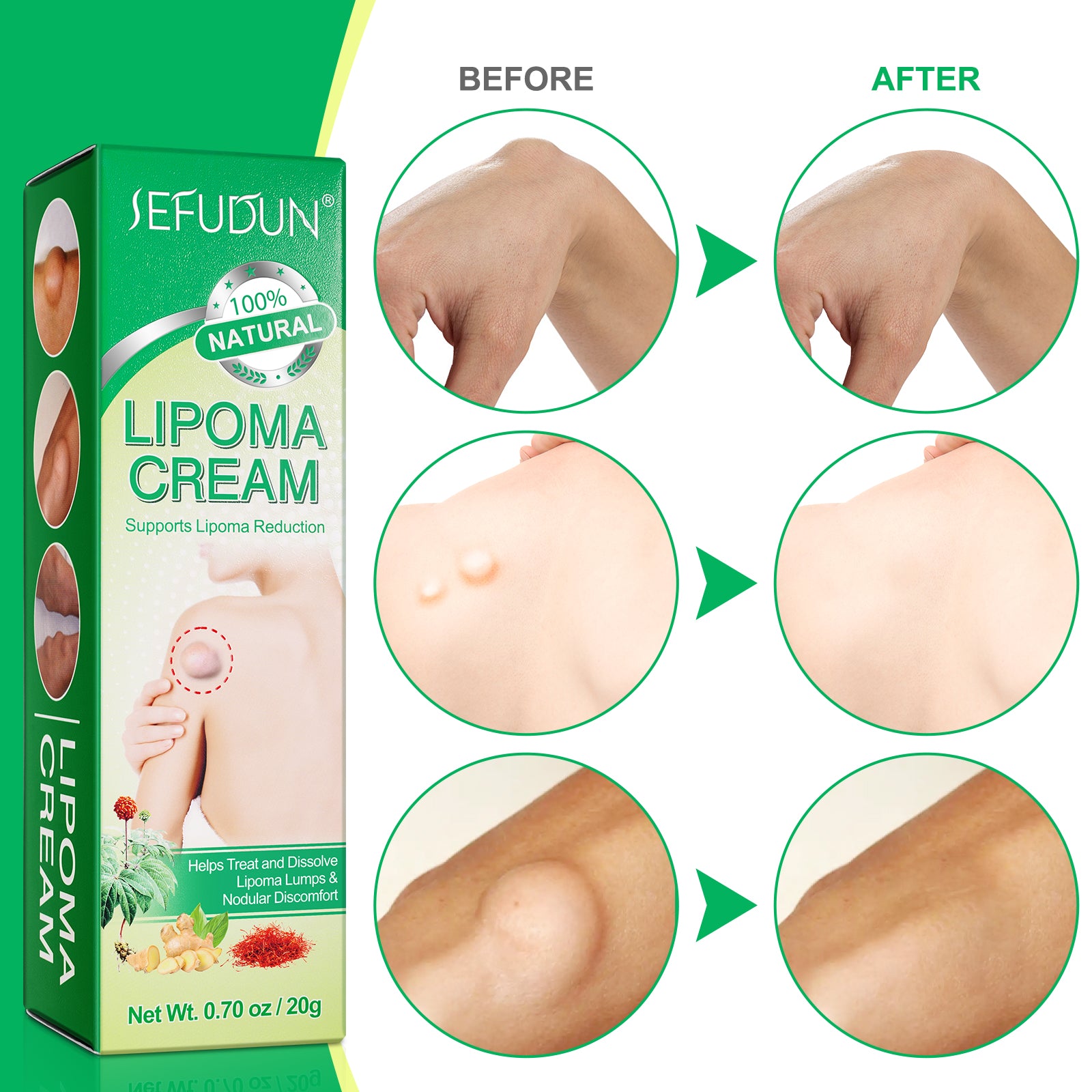 SEFUDUN Lipoma Removal Cream, 20g