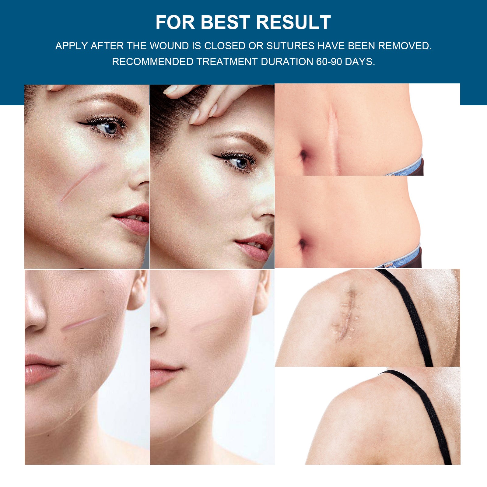 ELAIMEI Clear Silicone Scar Roll Tape, 1.5m