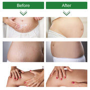 ELAIMEI Anti Stretch Mark Cream, 60ml